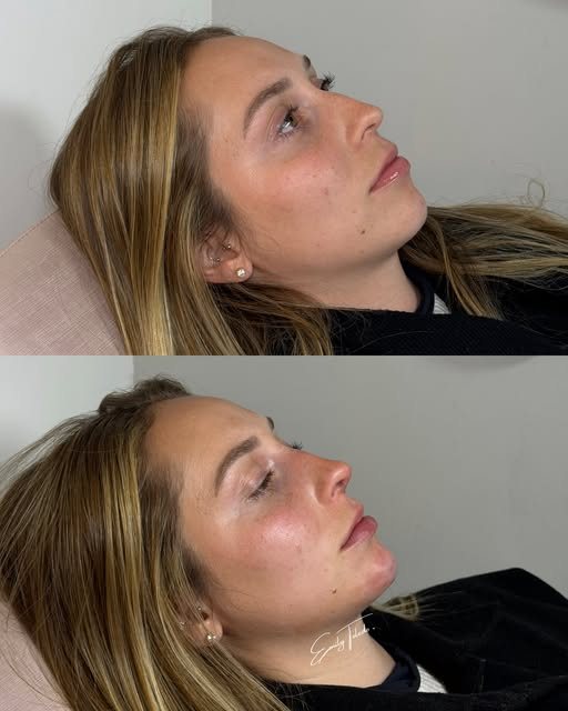 Antes e depois de harmonização do perfil