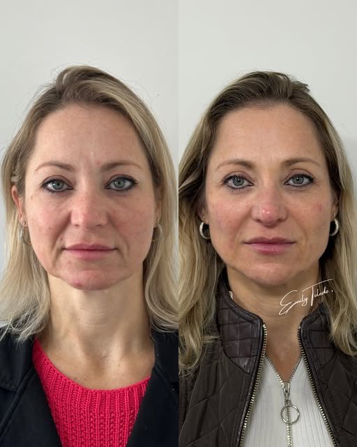 Antes e depois de rejuvenescimento facial